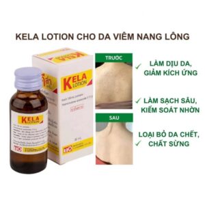 Kela Lotion trị viêm lỗ chân lông LCL Thai Lan - 60ml - EXP 20280522 - Image 2